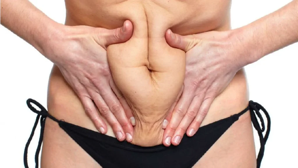 Los tratamientos para la flacidez evolucionan descubre Lipólisis Plus