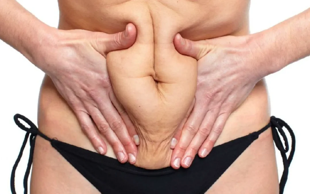 Los tratamientos para la flacidez evolucionan descubre Lipólisis Plus